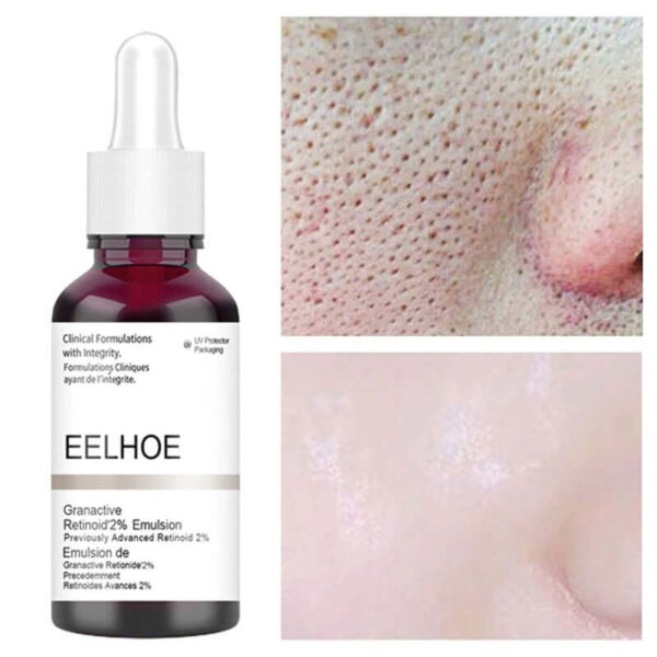 Anti Acne Exfoliating Face Serum Peeling Solution Pore Shrinking Face Skin Care Treatments serum