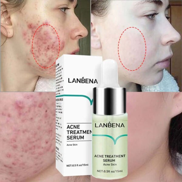 Anti-Acne Solution Face Essence Repair Pimples Scars Dark Spots Whitening Skin Shrink Pores serum