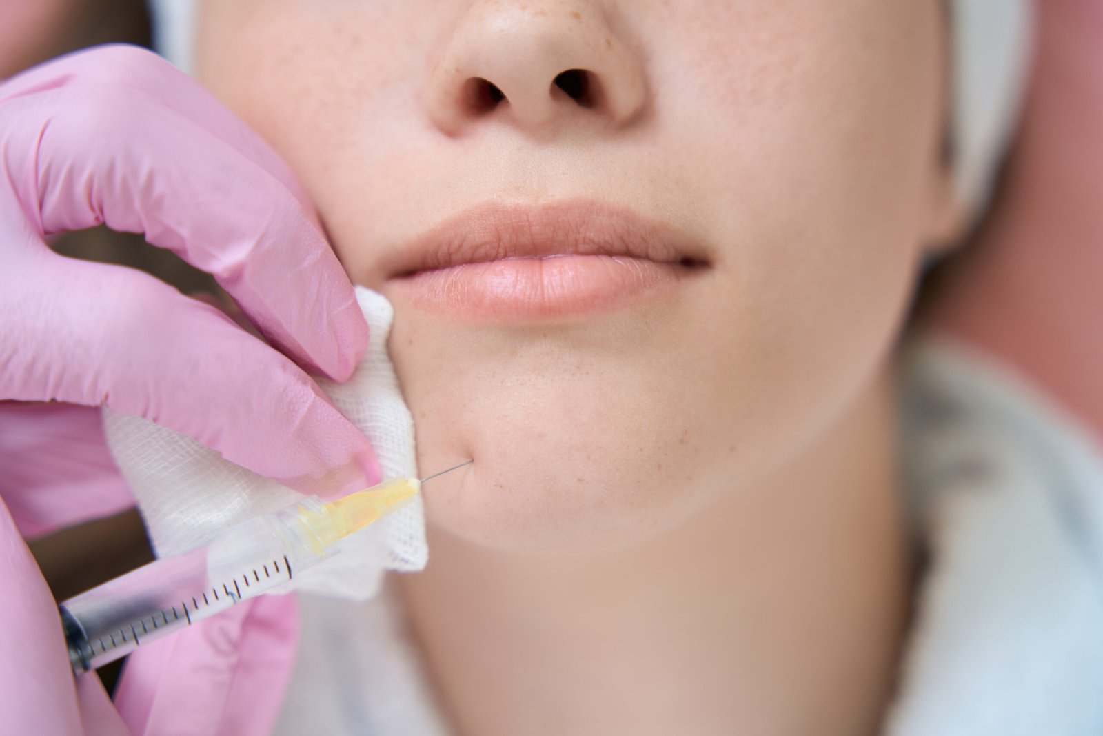 Dermal Fillers for Acne Scar Revision