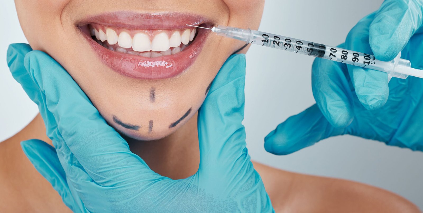 Using Botulinum Toxin for Gummy Smile Correction