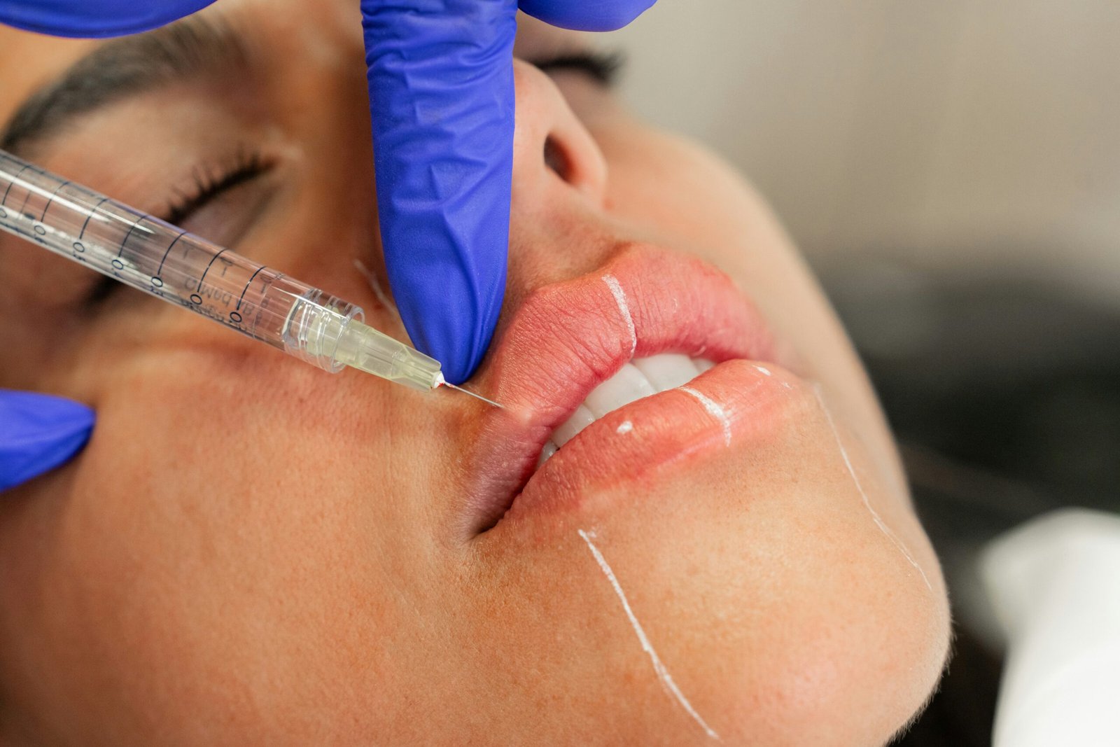 Dermal Fillers